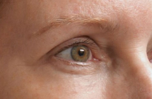 Patient After Treatment Close Up on Eye
