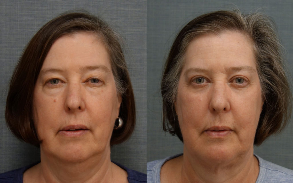 Bilateral Upper and Lower Eyelid Blepharoplasty, Eyelid Laser Resurfacing and FaceTite with Micro-Liposuction, Morpheus Microneedling Lower Face and Neck Patient 19-A 