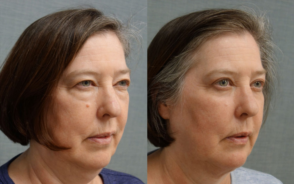 Bilateral Upper and Lower Eyelid Blepharoplasty, Eyelid Laser Resurfacing and FaceTite with Micro-Liposuction, Morpheus Microneedling Lower Face and Neck Patient 19-B 