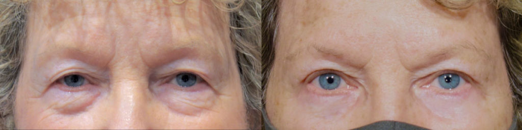 Upper and Lower Eyelid Blepharoplasty Patient 26 