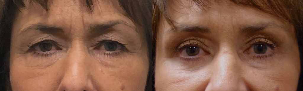 Upper Eyelid Blepharoplasty and Mini Brow Lift Patient 30-A 