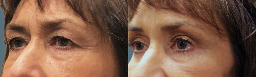 Upper Eyelid Blepharoplasty and Mini Brow Lift Patient 30-C 