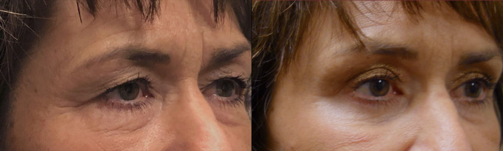 Upper Eyelid Blepharoplasty and Mini Brow Lift Patient 30-B 
