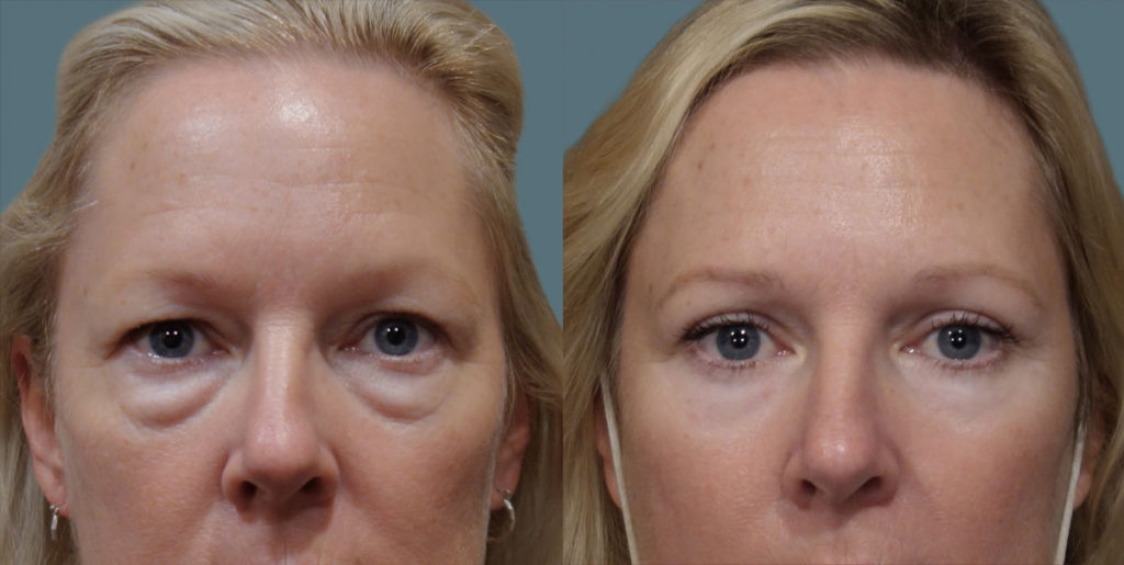 Upper and Lower Eyelid Blepharoplasty with Internal Cheek Elevation Patient 01-A 