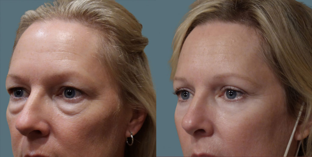 Upper and Lower Eyelid Blepharoplasty with Internal Cheek Elevation Patient 01-C 