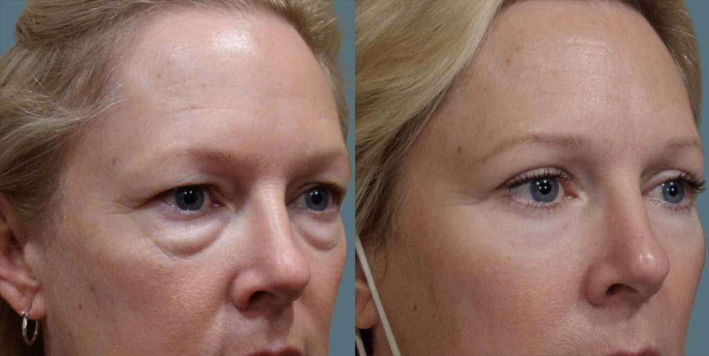 Upper and Lower Eyelid Blepharoplasty with Internal Cheek Elevation Patient 01-B 