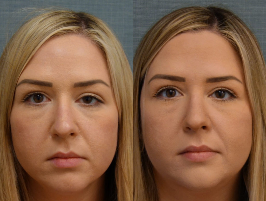 Upper Eyelid Blepharoplasty, Left Upper Eyelid External Ptosis Repair Patient 20-A 