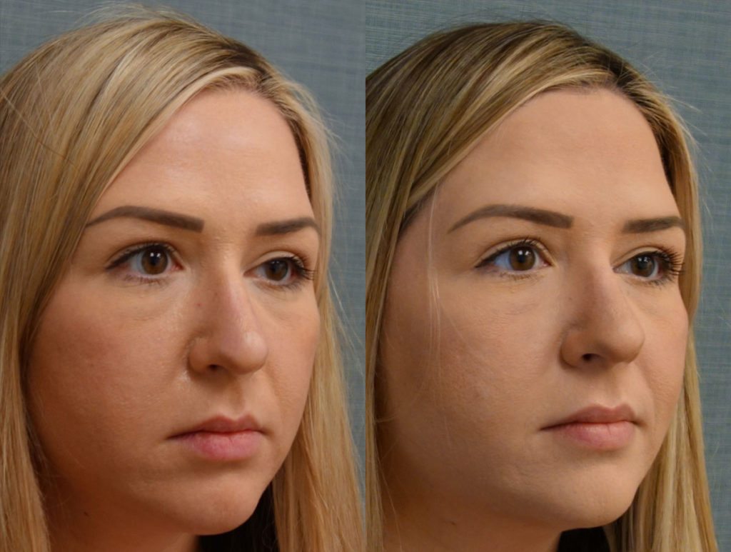 Upper Eyelid Blepharoplasty, Left Upper Eyelid External Ptosis Repair Patient 20-B 