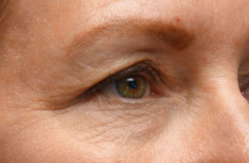 Patient Before Treatment Close Up on Eye