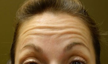 Botox Patient Front Angle Botox Patient Front Angle