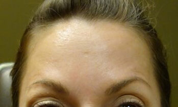 Botox Patient Front Angle Botox Patient Front Angle
