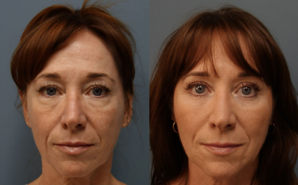 Upper and Lower Eyelid Blepharoplasty with Internal Cheek Elevation, Eyelid Laser Resurfacing, Facial Fat Grafting Patient 03-A 