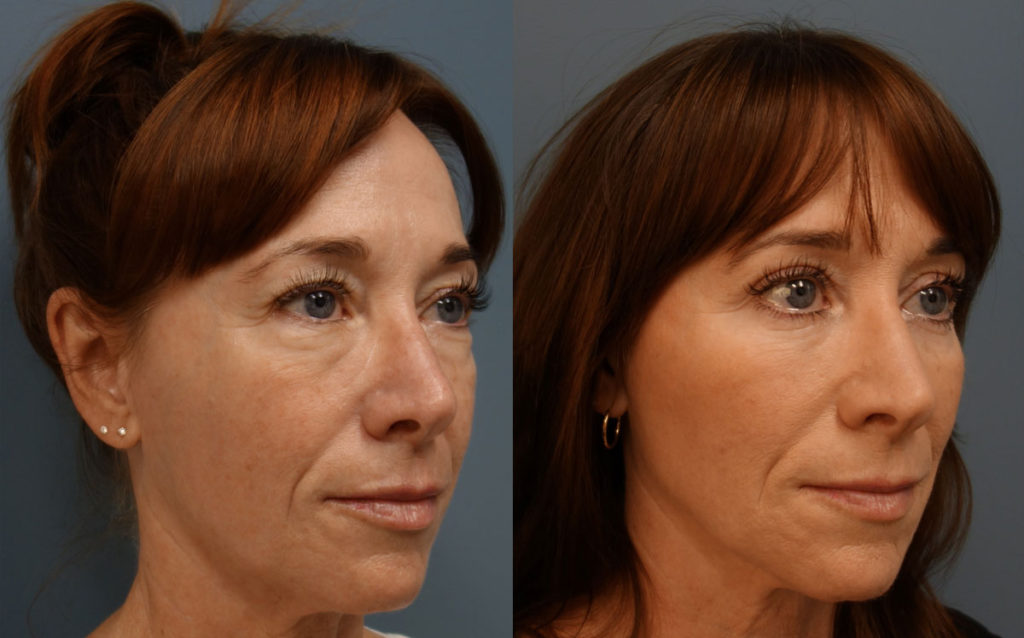 Upper and Lower Eyelid Blepharoplasty with Internal Cheek Elevation, Eyelid Laser Resurfacing, Facial Fat Grafting Patient 03-B 