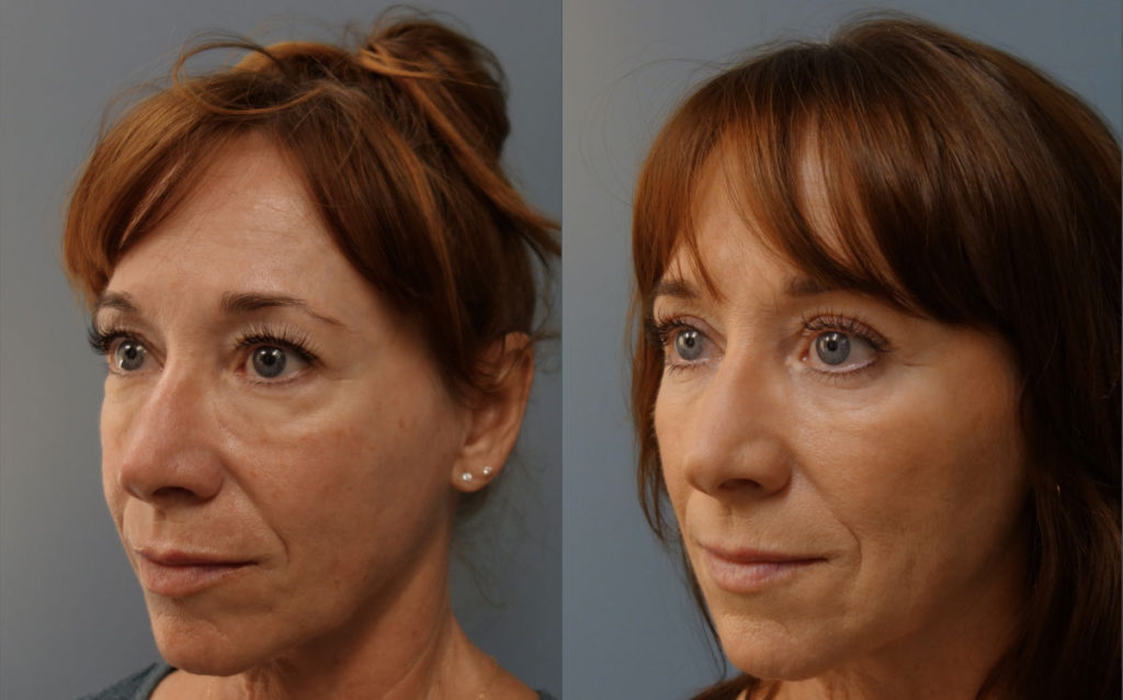 Upper and Lower Eyelid Blepharoplasty with Internal Cheek Elevation, Eyelid Laser Resurfacing, Facial Fat Grafting Patient 03-C 
