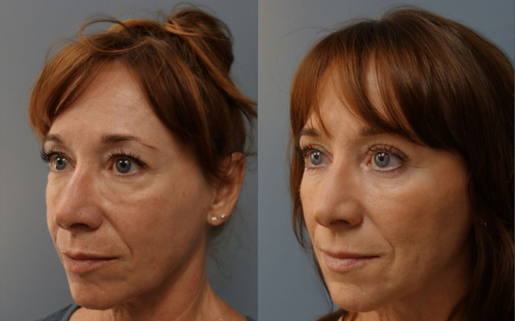 Upper and Lower Eyelid Blepharoplasty with Internal Cheek Elevation, Eyelid Laser Resurfacing, Facial Fat Grafting Patient 04-C 