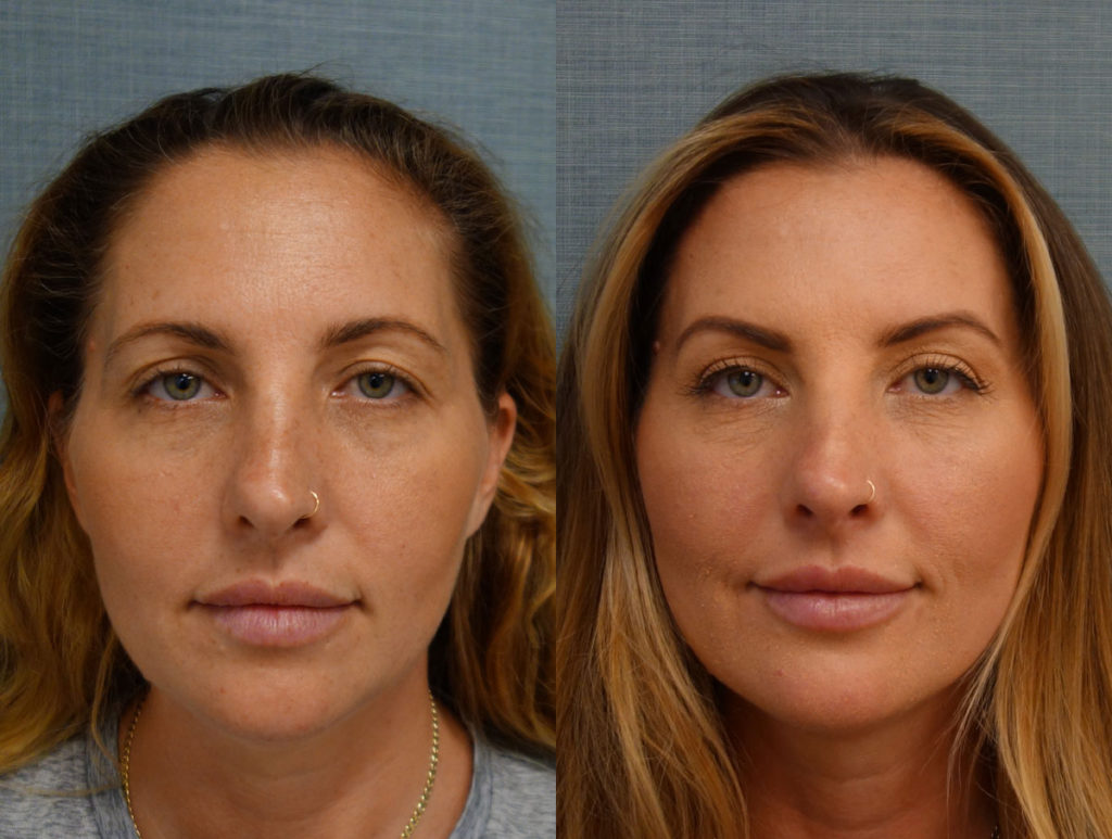 Upper Eyelid Blepharoplasty, Mini Brow Lift Patient 65-A 