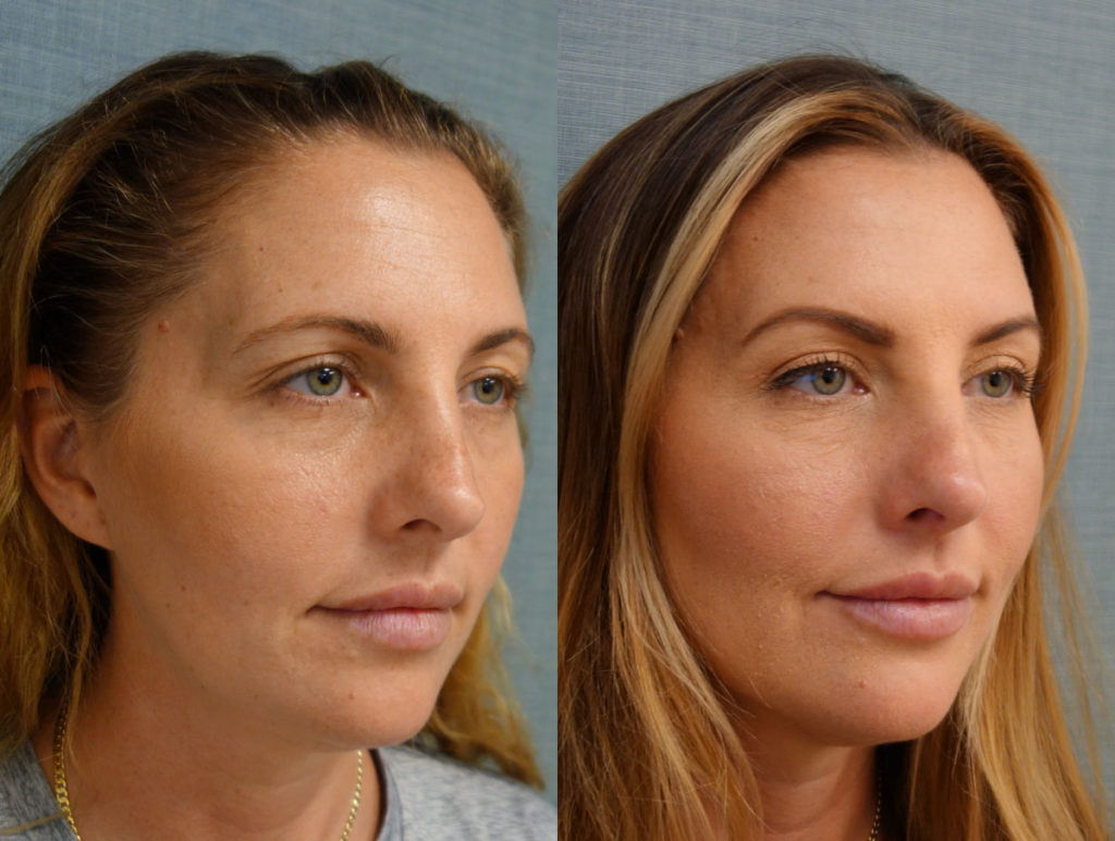 Bilateral Upper Eyeild Blepharopalsty, Mini Brow lift Patient 29-B 