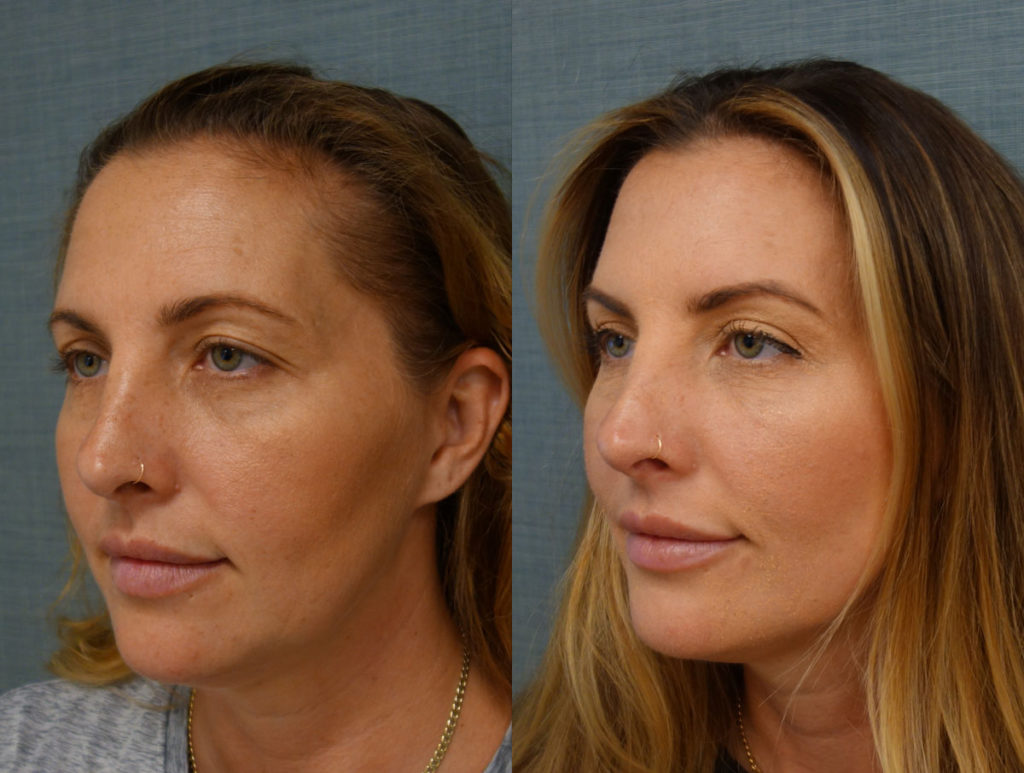 Bilateral Upper Eyeild Blepharopalsty, Mini Brow lift Patient 29-C 