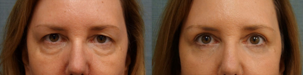 Upper and Lower Eyelid Blepharoplasty and Eyelid Chemical Peel Patient 15-A 