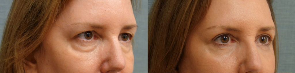 Upper and Lower Eyelid Blepharoplasty and Eyelid Chemical Peel Patient 15-B 