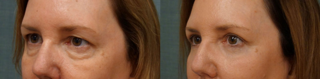 Upper and Lower Eyelid Blepharoplasty and Eyelid Chemical Peel Patient 15-C 