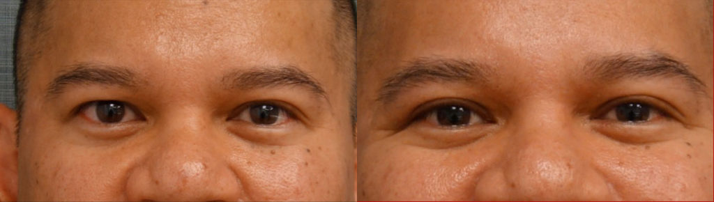 Right Upper Eyelid Blepharoplasty Patient 64-A 