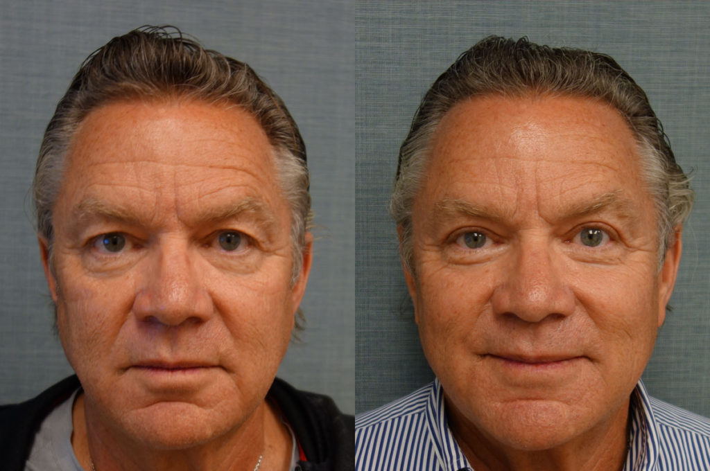 Bilateral Upper Eyelid Blepharoplasty Patient 63 