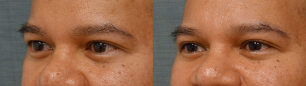 Right Upper Eyelid Blepharoplasty Patient 64-C 
