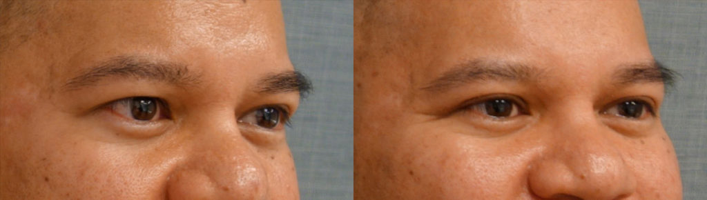 Right Upper Eyelid Blepharoplasty Patient 64-B 