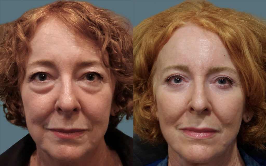 Upper and Lower Eyelid Blepharoplasty with Internal Cheek Elevation and Chemical Peel Patient 06-A 