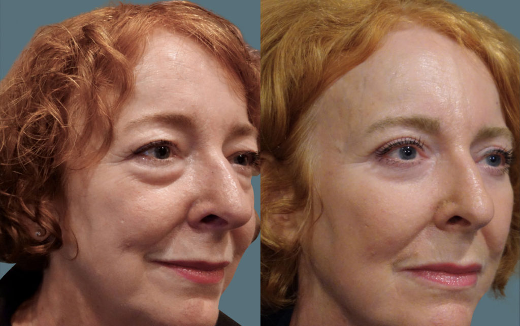Upper and Lower Eyelid Blepharoplasty with Internal Cheek Elevation and Chemical Peel Patient 06-B 