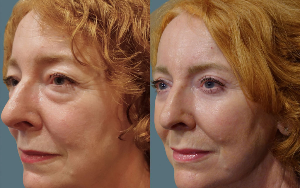 Upper and Lower Eyelid Blepharoplasty with Internal Cheek Elevation and Chemical Peel Patient 06-C 
