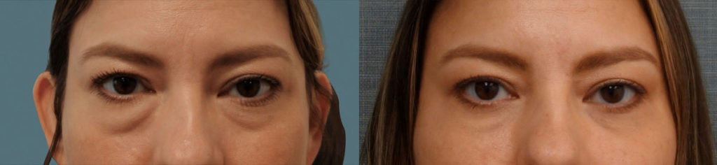 Bilateral Lower Eyelid Blepharoplasty, Fat Grafting Patient 13-A 