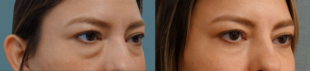 Bilateral Lower Eyelid Blepharoplasty, Fat Grafting Patient 13-B 