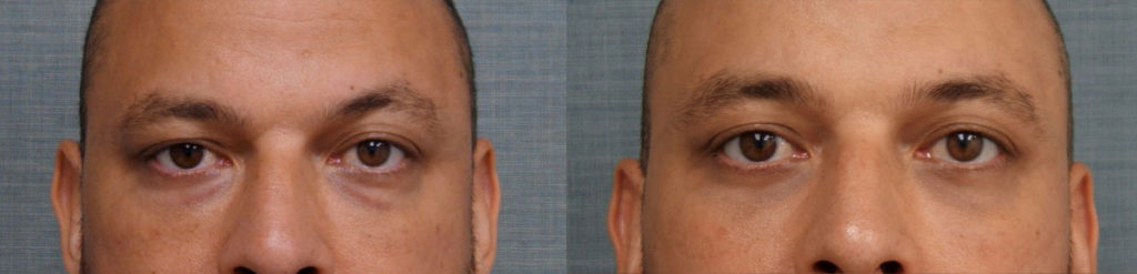 Bilateral Lower Eyelid Blepharoplasty Patient 11-A 