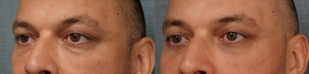 Bilateral Lower Eyelid Blepharoplasty Patient 11-B 