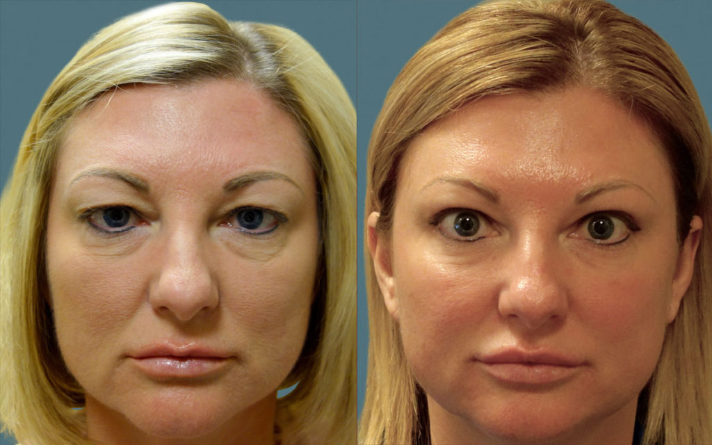 Upper and Lower Eyelid Blepharoplasty Patient 31-A 