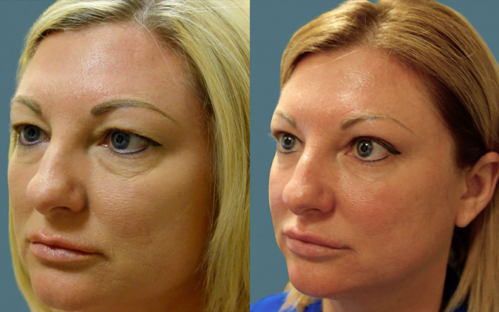 Upper and Lower Eyelid Blepharoplasty Patient 31-B 