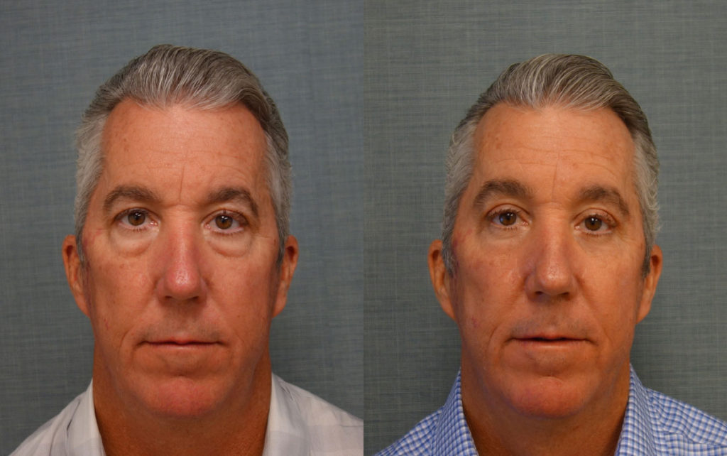 Bilateral Upper Eyelid Blepharoplasty, Bilateral Lower Eyelid Blepharoplasty, Direct Brow Lift, Chemical peel to Bilateral Lower Eyelids. Patient 37 