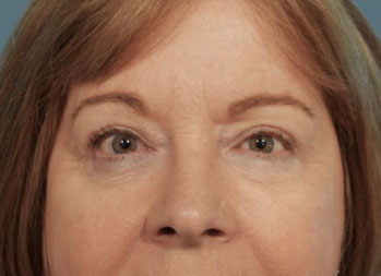 After Eye Centered Cosmetic Surgery Patient Front Angle