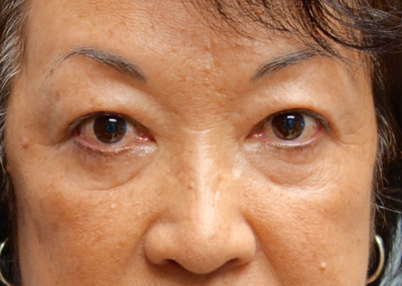 After Asian Blepharoplasty 1 Front Angle
