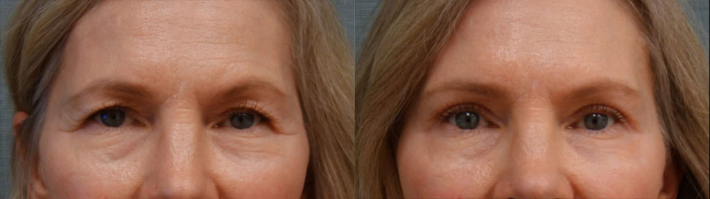 Upper Eyelid Blepharoplasty, Mini Brow Lift Patient 01-A 