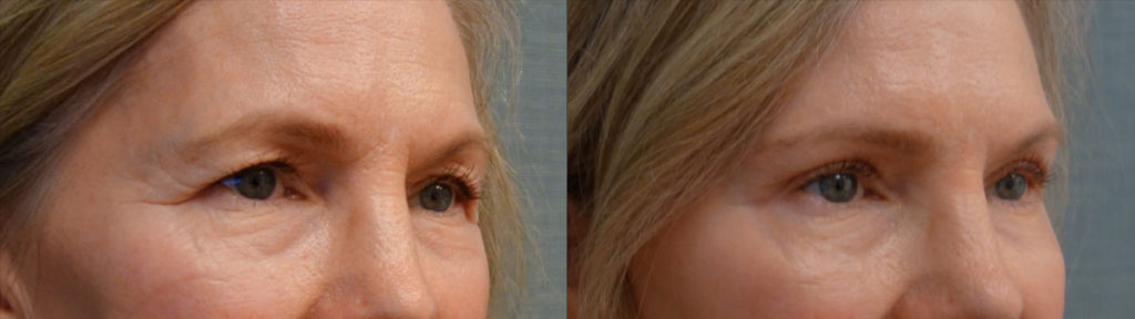 Upper Eyelid Blepharoplasty, Mini Brow Lift Patient 01-B 