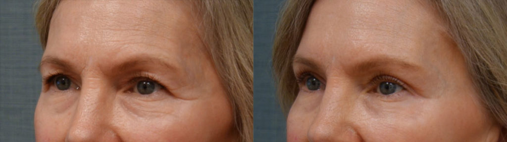 Upper Eyelid Blepharoplasty, Mini Brow Lift Patient 01-C 