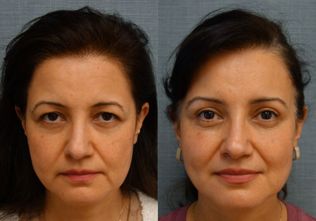 Upper Eyelid Blepharoplasty, Mini Brow Lift Patient 02-A 