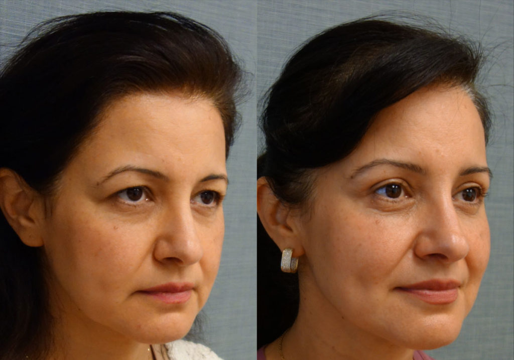 Upper Eyelid Blepharoplasty, Mini Brow Lift Patient 02-B 