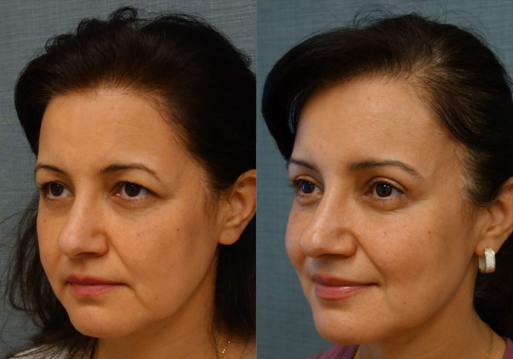 Upper Eyelid Blepharoplasty, Mini Brow Lift Patient 02-C 