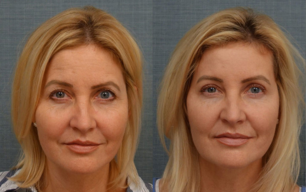 Upper Eyelid Blepharoplasty, Mini Brow Lift Patient 21-A 