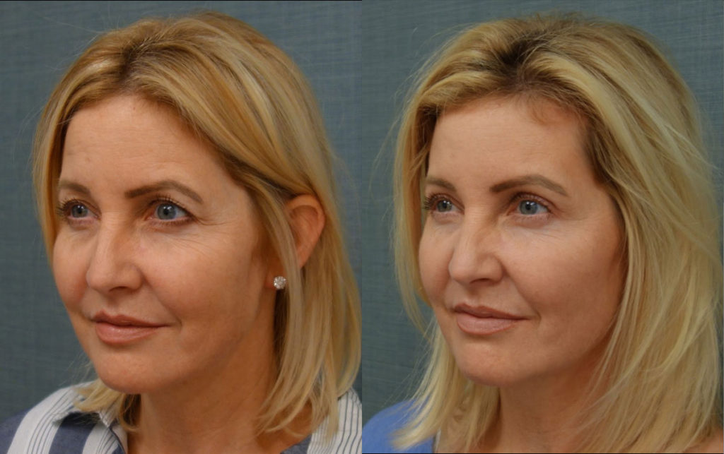 Upper Eyelid Blepharoplasty, Mini Brow Lift Patient 21-B 