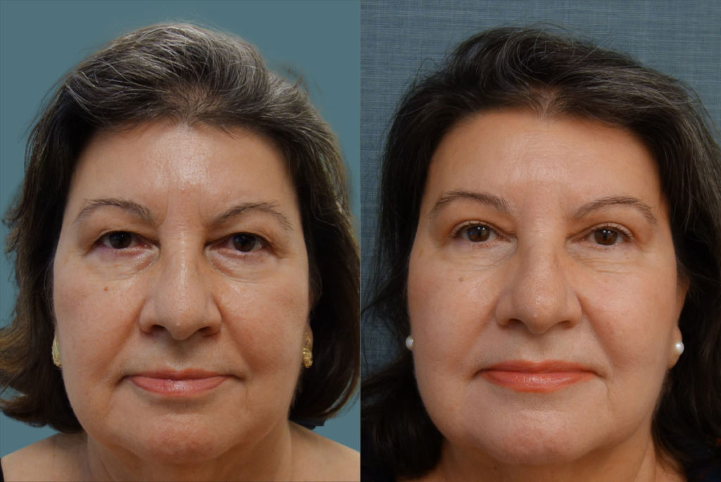 Upper Eyelid Blepharoplasty, Mini Brow Lift Patient 06-A 